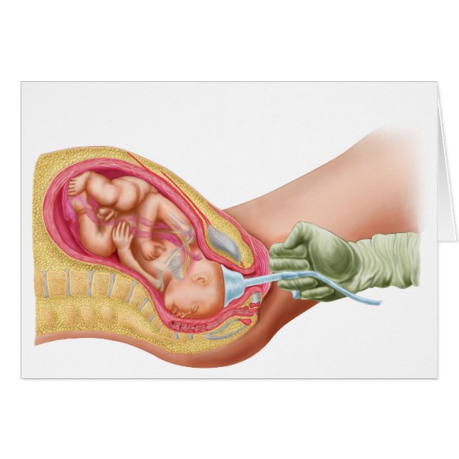 Lieferung von Fetus mithilfe der Vakuumextrahierun (Vorderseite (Horizontal))