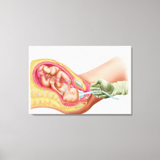 Lieferung von Fetus mithilfe der Vakuumextrahierun Leinwanddruck