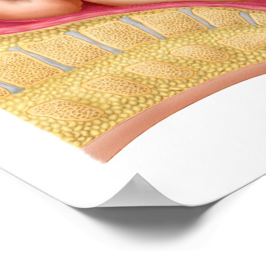 Lieferung von Fetus mithilfe der Vakuumextrahierun Poster (Ecke)