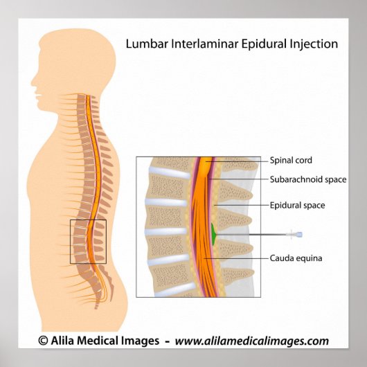 Lumbar epidurale Injektion, beschriftet. Poster (Vorne)