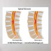 Lumbar Spinale Stenosis, medizinisches zeichn. Poster (Vorne)