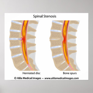 Lumbar Spinale Stenosis, medizinisches zeichn. Poster