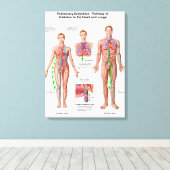 Lungenembolie, Embolusweg Leinwanddruck (Insitu (Holzboden))
