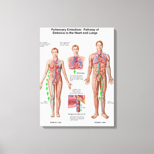 Lungenembolie, Embolusweg Leinwanddruck (Vorderseite)