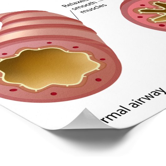 Lungenerkrankung Asthma Poster (Ecke)