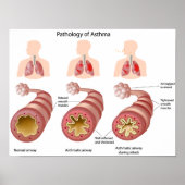 Lungenerkrankung Asthma Poster (Vorne)
