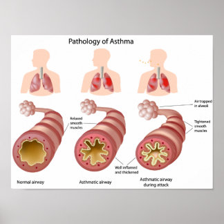 Lungenerkrankung Asthma Poster