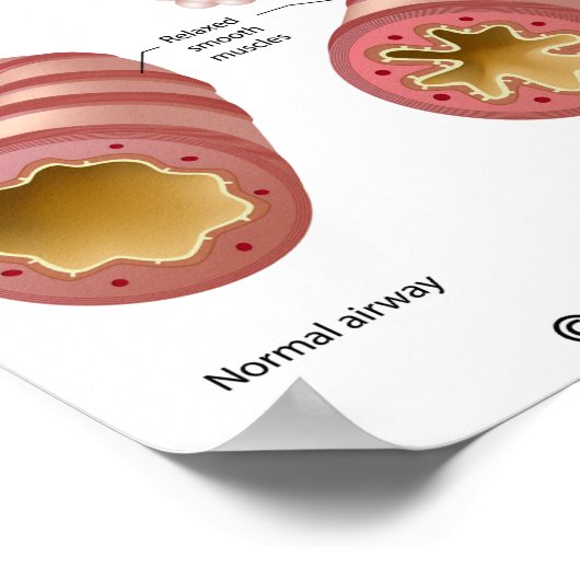 Lungenerkrankung Asthma Poster (Ecke)