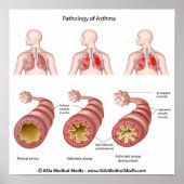 Lungenerkrankung Asthma Poster (Vorne)
