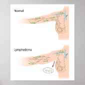 lymphödem Arm-Diagramm Poster (Vorne)