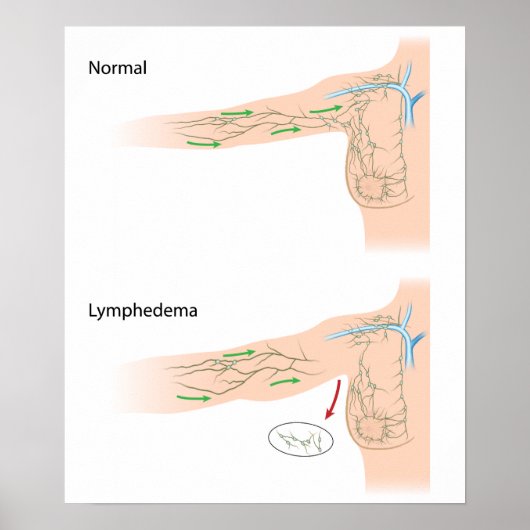 lymphödem Arm-Diagramm Poster (Vorne)