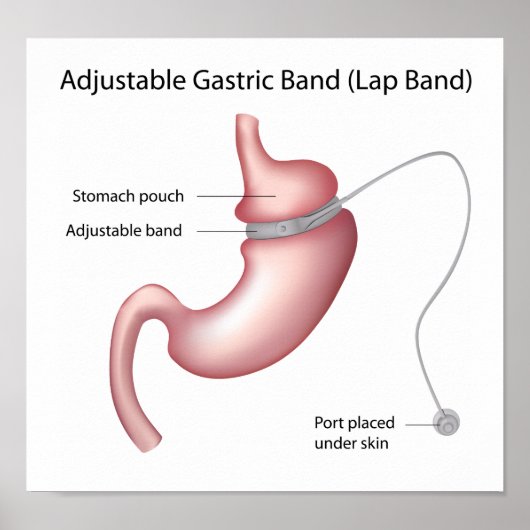 Magenband Gewichtsverlust Operation Poster (Vorne)