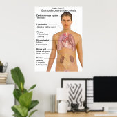 Main Symptoms of Extrapulmonary Tuberculosis Chart Poster (Heimbüro)