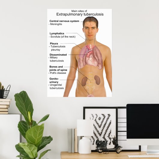Main Symptoms of Extrapulmonary Tuberculosis Chart Poster (Heimbüro)