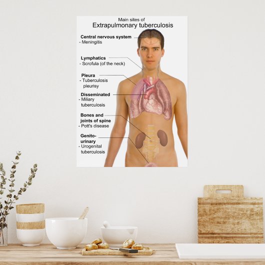 Main Symptoms of Extrapulmonary Tuberculosis Chart Poster (Küche)