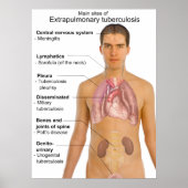 Main Symptoms of Extrapulmonary Tuberculosis Chart Poster (Vorne)