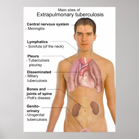 Main Symptoms of Extrapulmonary Tuberculosis Chart Poster (Vorne)