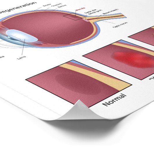 Makuladegeneration Poster (Ecke)