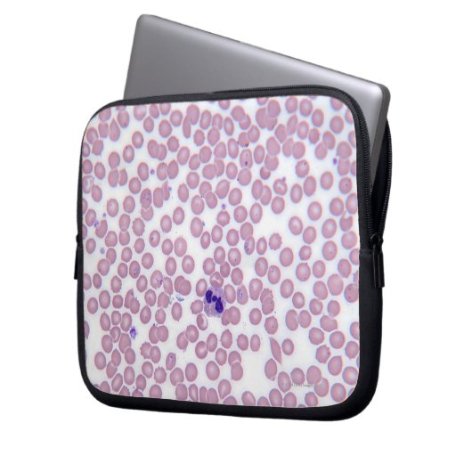 Malariablutzellen Laptopschutzhülle (Vorderseite Links)