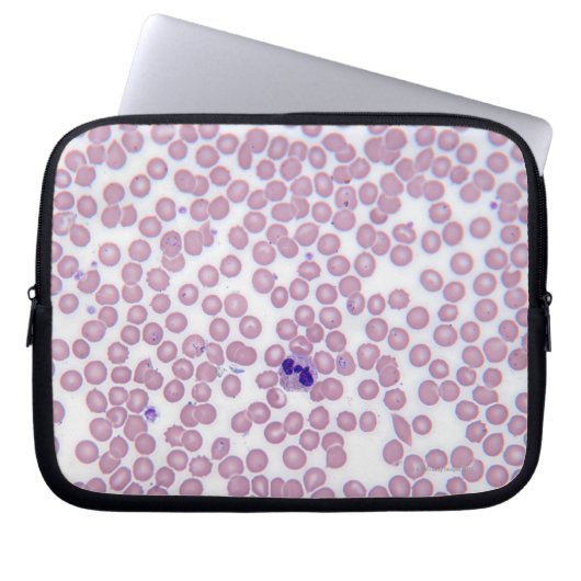 Malariablutzellen Laptopschutzhülle (Vorderseite)