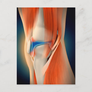Medical Illustration: Inflammation In Knee Postkarte
