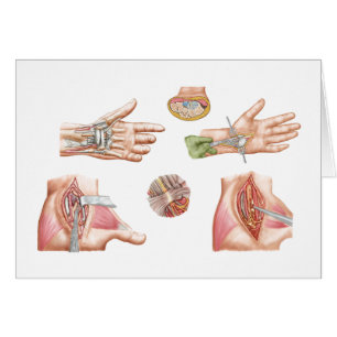 Medizinische Illustration, die Carpal-Tunnel zeigt