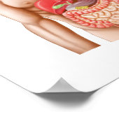 Medizinische Ilustration einer Hiatalhernie in der Poster (Ecke)