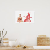 Medizinische Ilustration einer Hiatalhernie in der Poster (Küche)