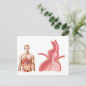 Medizinische Ilustration einer Hiatalhernie in der Postkarte (Stehend Vorderseite)