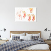Medizinische Ilustration einer Pilonidalzyste Leinwanddruck (Insitu (Schlafzimmer))