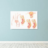 Medizinische Ilustration einer Pilonidalzyste Leinwanddruck (Insitu (Holzboden))