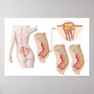 Medizinische Ilustration einer Pilonidalzyste Poster