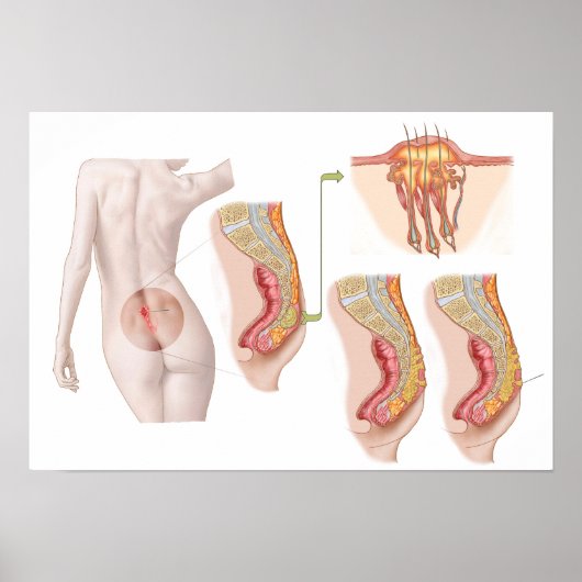 Medizinische Ilustration einer Pilonidalzyste Poster (Vorne)