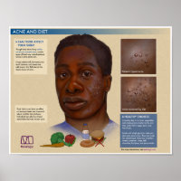 Melalogic Akne and Diet Medical Poster