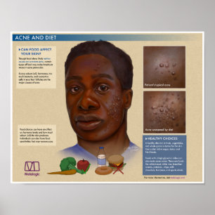 Melalogic Akne and Diet Medical Poster