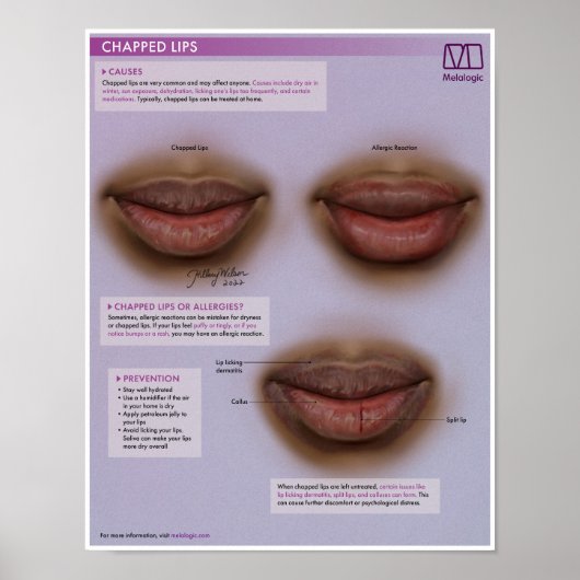 Melalogic Chapped Lips Medical Poster (Vorne)