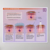 Melalogic Hyperhidrosis Medical Poster (Vorne)