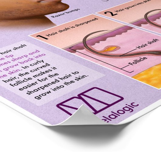 Melalogic Razor Bumps and Keloids Medical Poster (Ecke)