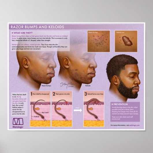 Melalogic Razor Bumps and Keloids Medical Poster (Vorne)