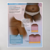 Melalogic Stretch Markus Medical Poster (Vorne)