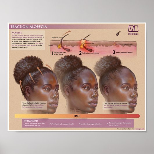 Melalogic Traction Alopezie Medikales Poster (Vorne)