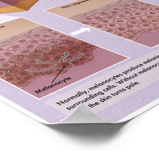 Melalogic Vitiligo Medical Poster (Ecke)