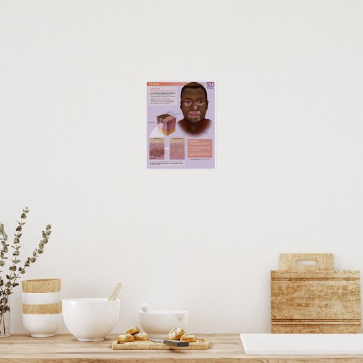 Melalogic Vitiligo Medical Poster (Küche)