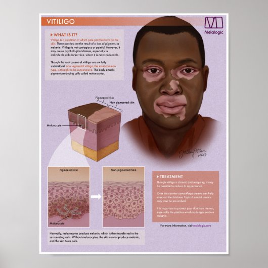 Melalogic Vitiligo Medical Poster (Vorne)