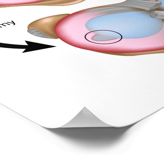 Meniskusriss und Operation Poster (Ecke)