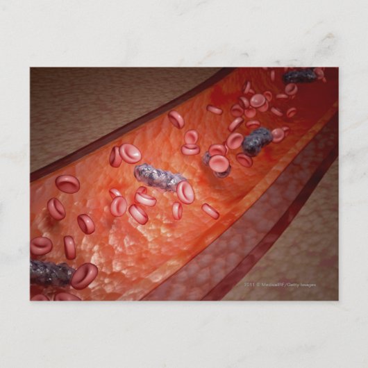 Mikroskopische Darstellung einer Blutinfektion Postkarte (Vorderseite)