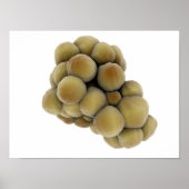 Mikroskopische Tumoransicht 5 Poster (Vorne)