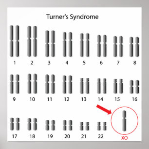 Monosomy X, Turner-Syndrom Poster