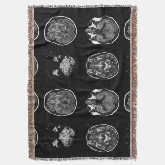 MRT des Gehirns Decke (Vorderseite Vertikal)