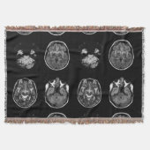 MRT des Gehirns Decke (Vorderseite)